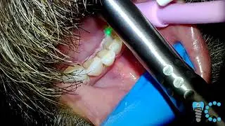 Dr. Hanna Hobbs | Periodontics with IC HeadCam