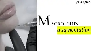 Macro chin augmentation #KAMINSKYI