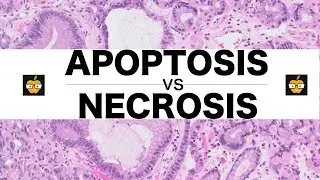 Apoptosis (Intrinsic, Extrinsic Pathways) vs. Necrosis