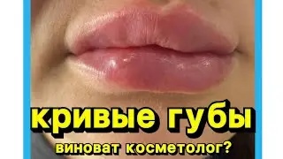 Кривые губы после инъекций красоты! Виноват косметолог или клиент? Разбираемся