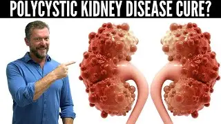 Polycystic Kidney Disease Breakthrough (New Research in PKD) - 2024