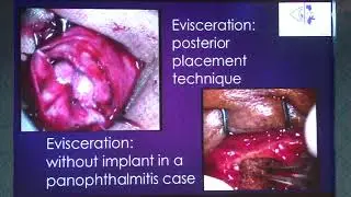 AIOC2019   IC69    Topic    Enucleation or evisceration  what is the right choice to get a healthy s