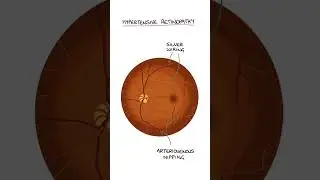 Hypertensive Retinopathy #medicine #medicalstudent #ophthalmology #optometrystudent