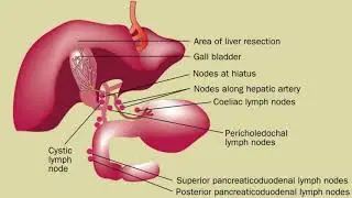 Difference Between Cholecystitis and Cholelithiasis