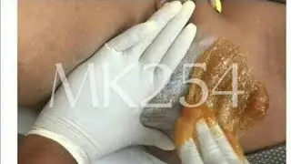 BRAZILIAN BIKINI LINE SUGAR WAXING AT HOME #viral