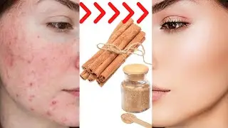 how to remove pimples overnight | acne treatment | remove acne pimples fast easy & effective!!!