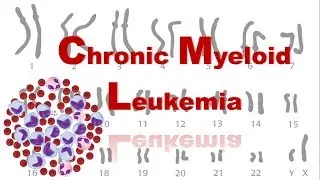 Chronic Myeloid Leukemia | CML | Philadelphia Chromosome