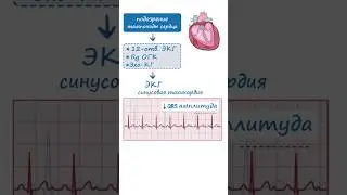 Тампонада сердца ЭКГ признаки