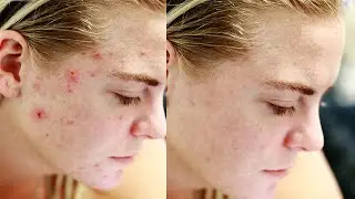 power of spot healing brush tool Photoshop remove pimple tutorial