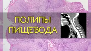 Полипы пищевода | Патология