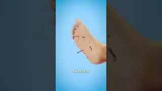 How To Remove Sea Urchin Spines 😬