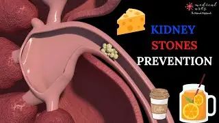 HOW TO PREVENT KIDNEY STONES - Natural remedies
