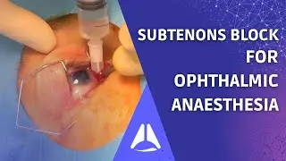 Subtenon's block regional anaesthesia for ophthalmic surgery. Live patient UPDATE!