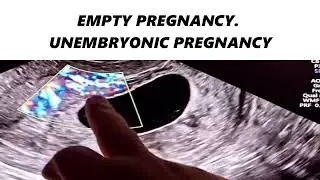 EMPTY PREGNANCY. UNEMBRYONIC PREGNANCY #ultrasound #pregnancytest #pregnancy