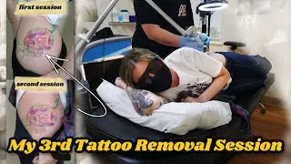 My Third Tattoo Removal Session: Potentially my last!