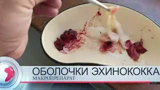 Оболочки эхинококка.