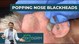 Popping Nose Blackheads | Dr. Derm