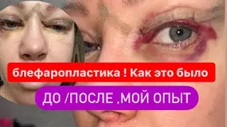 Блефаропластика до /после , мой опыт 