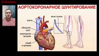 Шунтирование сосудов сердца. Ахмадудинов А.М.