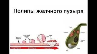 Полипы желчного пузыря