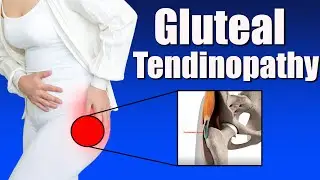 Gluteal Tendinopathy: Symptoms, Causes, and Effective Exercises for Greater Trochanter Pain