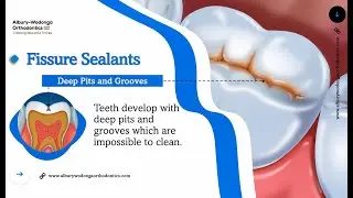 Fissure Sealants_V1