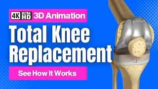 Total Knee Replacement - See How It Works - 3D Animation