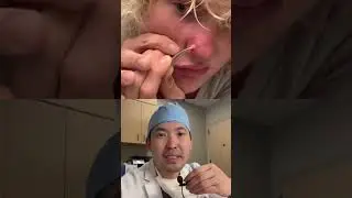 Dr. Sugai Reacts: Home Pimple Extraction!