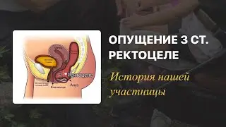 Опущение 3 степени. Ректоцеле. Операция отложена врачом. Как такое возможно?