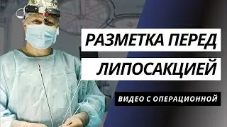 РАЗМЕТКА ПЕРЕД ЛИПОСАКЦИЕЙ ✍️ | ЛИПОСАКЦИЯ ЖИВОТА, БОКОВ И ФЛАНКОВ | ЛИПОСАКЦИЯ КИЕВ