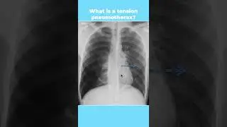 What is a tension pneumothorax? #shorts