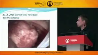 Эндоскопическая папиллэктомия