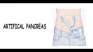 ARTIFICAL PANCREAS