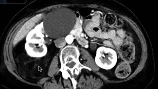 Liposarcoma