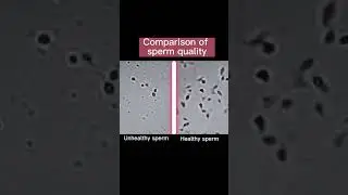 Sperm quality comparison,Which one are you？#ivf #ivfbaby #ttc #ttcjourney #fertility  #life #icsi