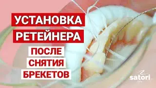 Установка ретейнера после снятия брекетов