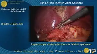 Laparoscopic cholecystectomy for Mirizzi syndrome