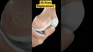 3D Knee Replacement Animation✓✓• #kneereplacementoperation #3danimation #3d #kneearthritis #kneepain