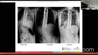 Surgical correction of Idiopathic Scoliosis