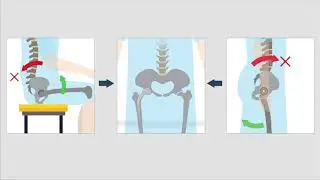 Late Dislocation Following Total Hip Arthroplasty