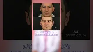 Отопластика До и После
