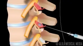 Lumbar Facet Joint Injection Procedure Animation