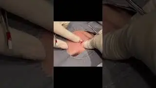 Marshmellow Cyst!