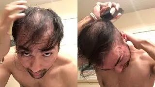 BALDING AT 26 - Tired Of Going Bald NOW I'm Shaving My Head *Incredible Journey*