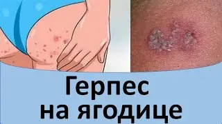 Герпес на ягодице