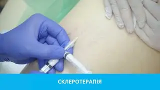 Склеротерапія в Оксфорд Медікал