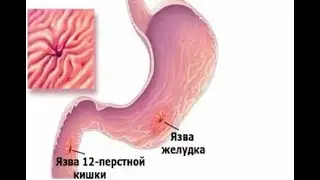 Язвенная болезнь желудка и 12-перстной кишки. Причины, симптомы, стадии и сроки рубцевания язвы