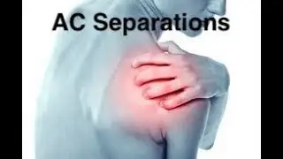 Does an AC Separation or a Separated Shoulder Require Surgery?