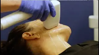 Sofwave  - Non-Invasive Ultrasound Face and Neck Wrinkle Treatment