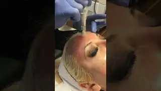 Microneedling to stimulate collagen #shorts #skincare